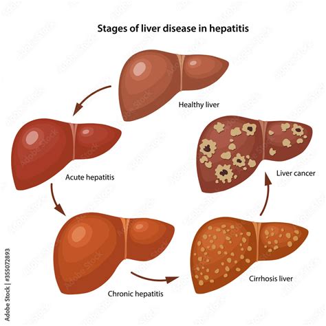 Viral Hepatitis and Liver Disease .